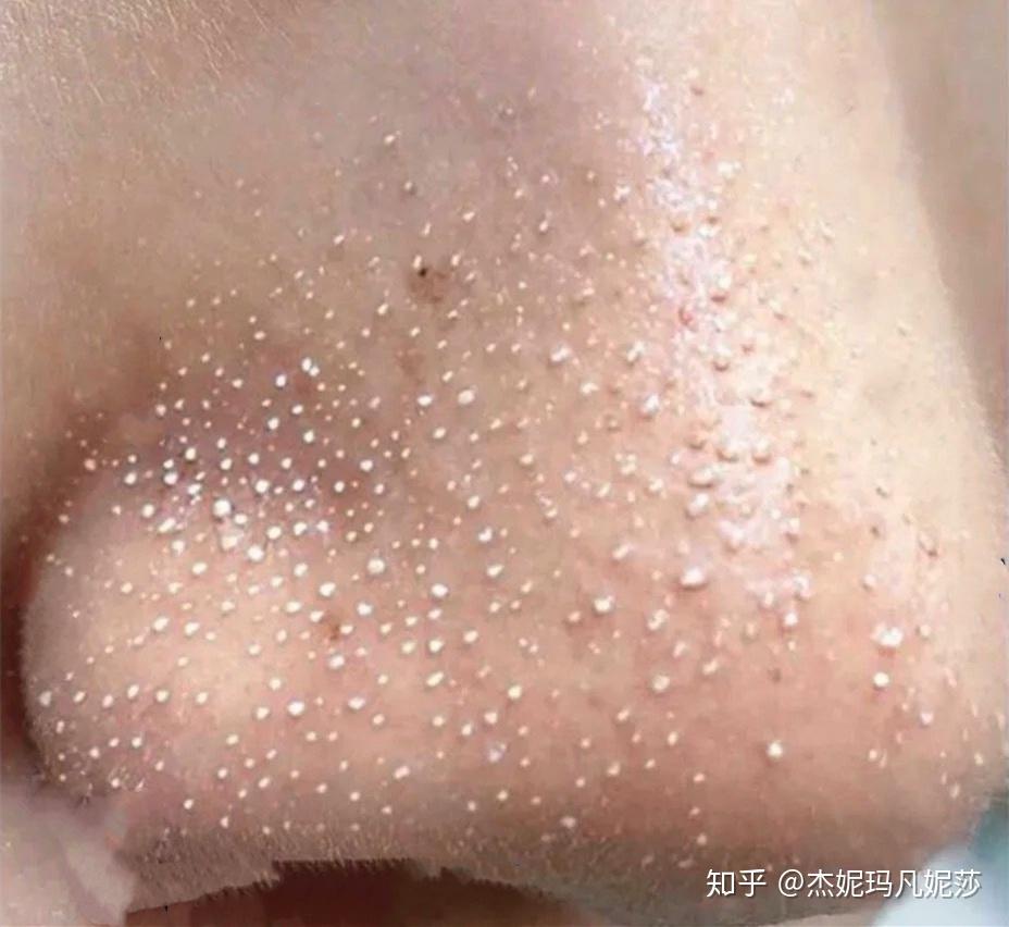 你们去过医院看过黑头吗