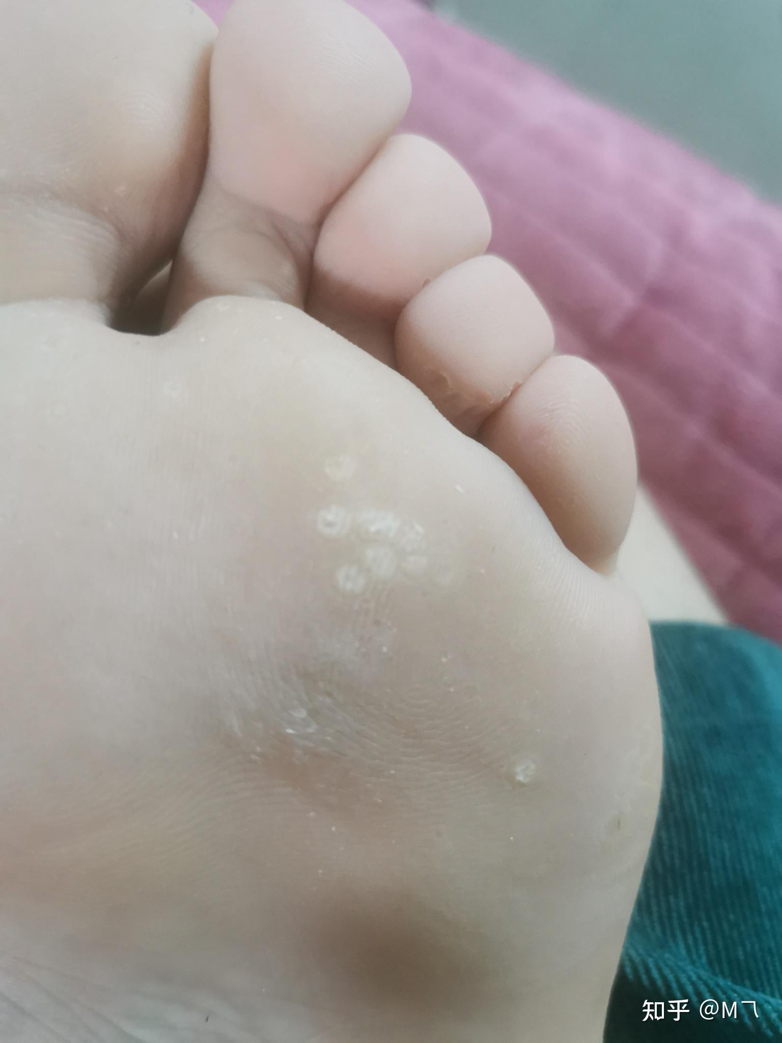泡完脚发现脚底板上有很多白泡,不痛不痒,谁知道这是什么? 