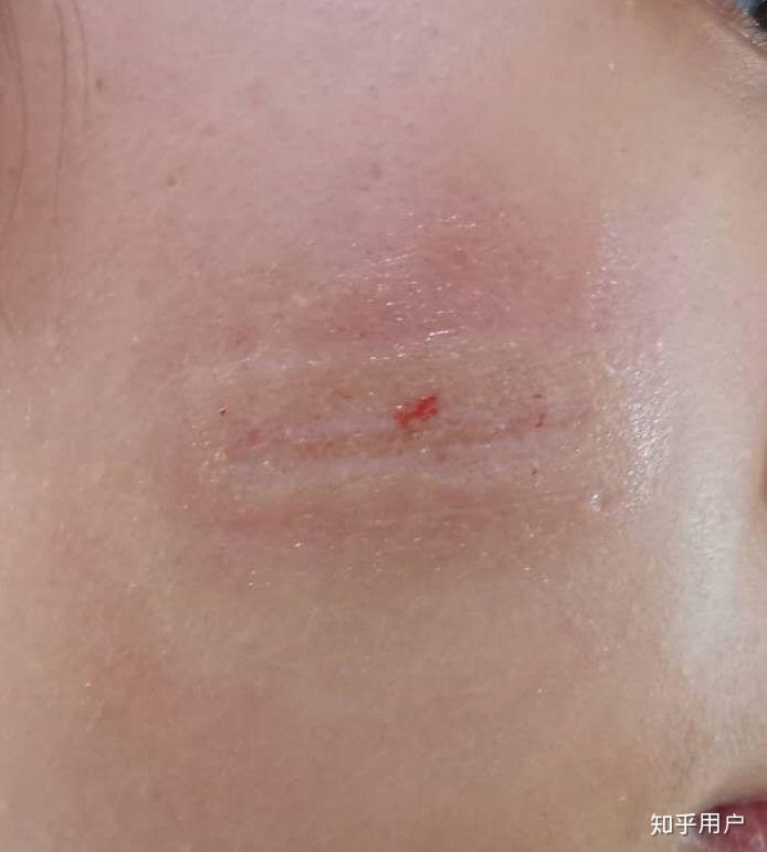 小时候打架脸上被抓了很多疤痕,可以怎么修复疤痕? - 知乎