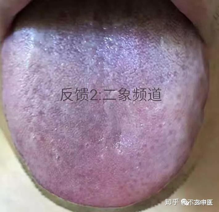 舌头上有紫色淤点图片图片