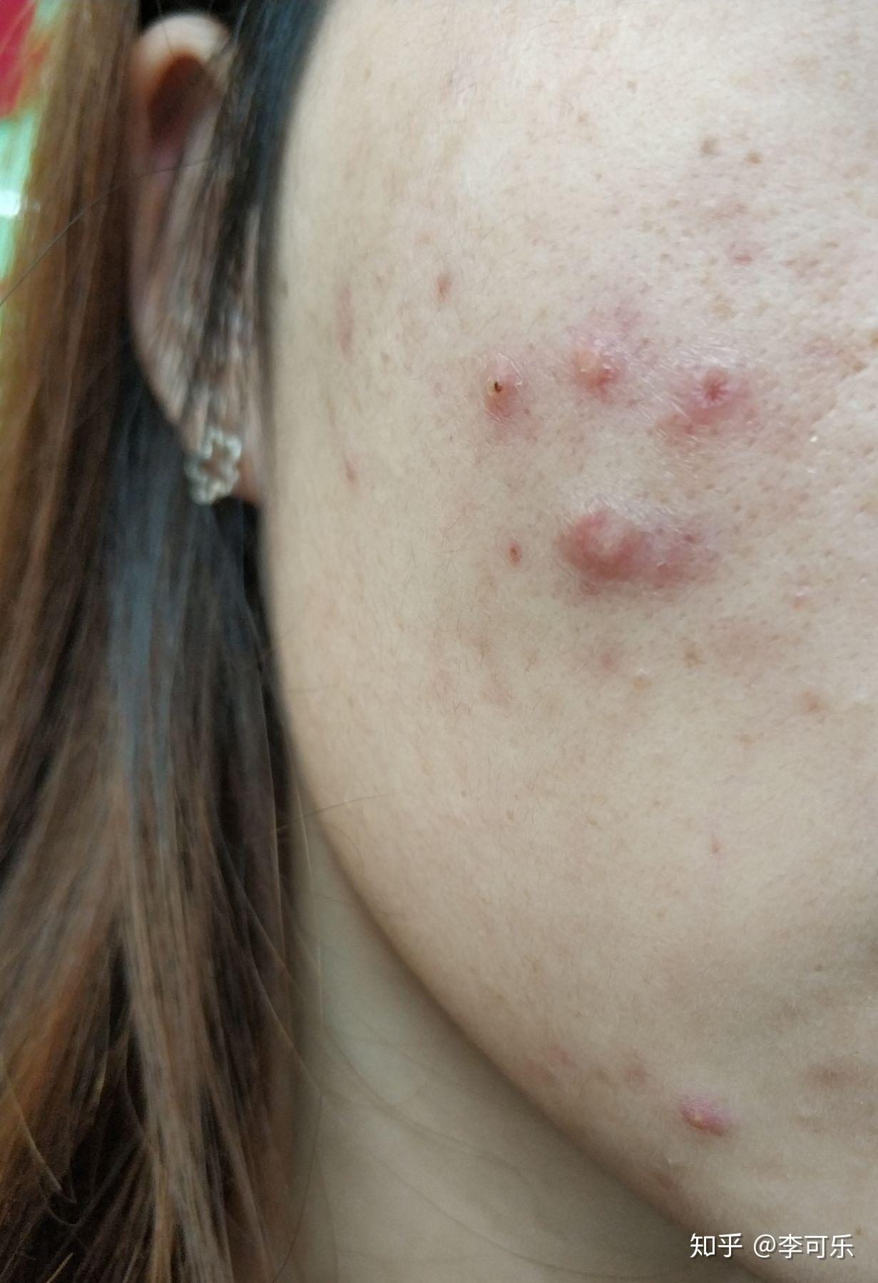 中度痤疮服用异维a酸胶囊记录