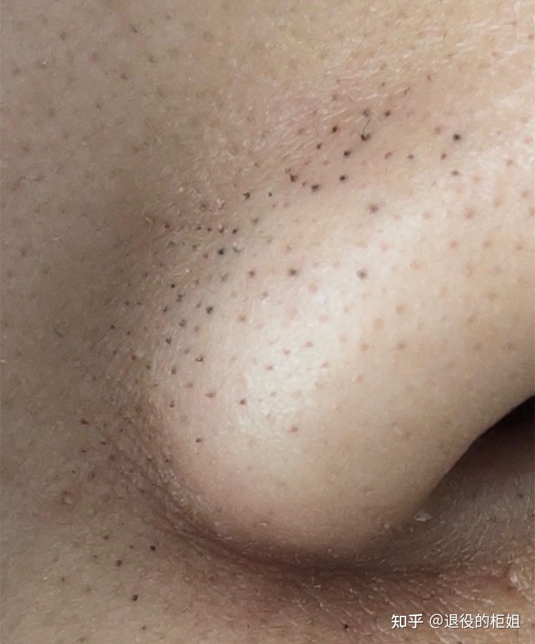 假黑头之一,毳毛型黑头,小刺毛壅症 - 知乎