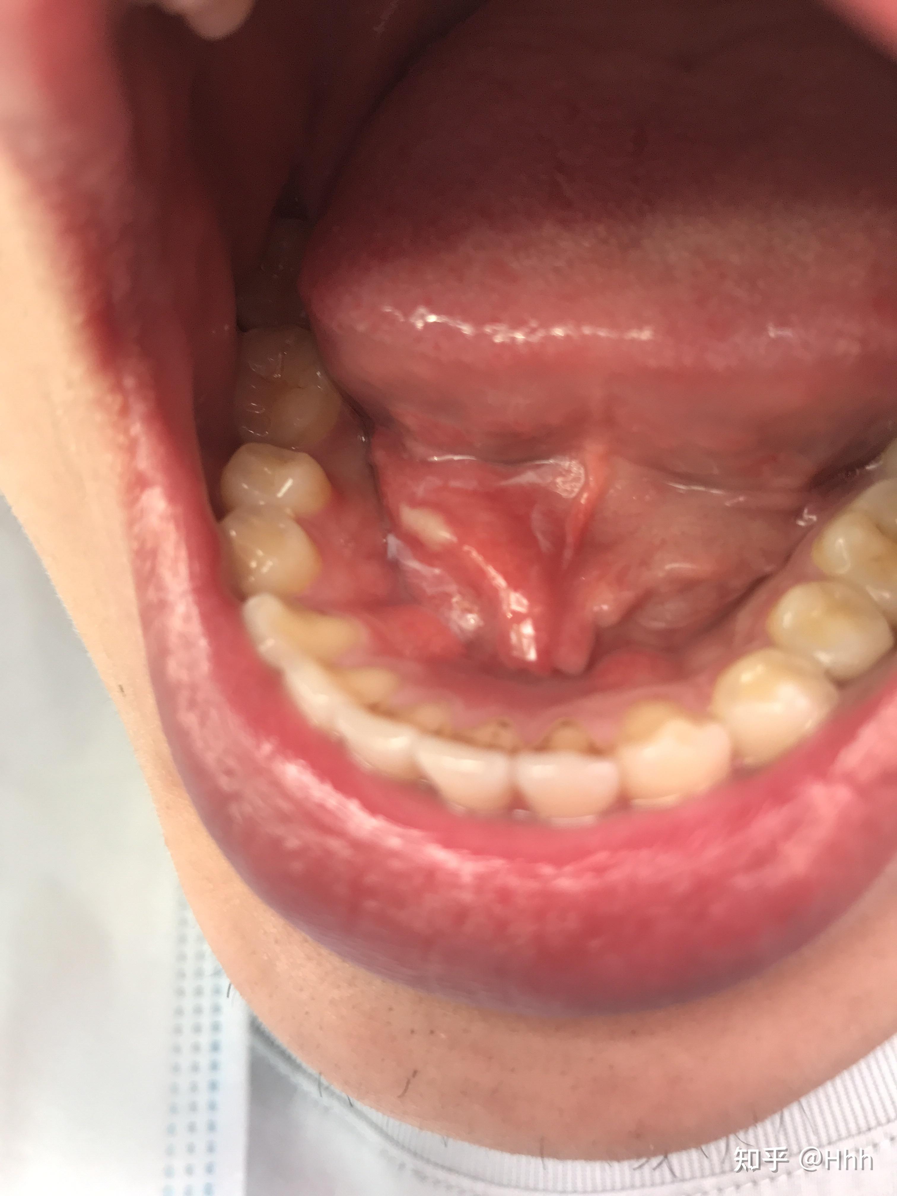 舌下白色溃疡图片图片