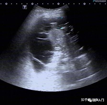 胸腔积液的超声诊断,既简单又复杂