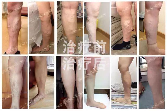 有人在张强医生集团做过静脉曲张手术吗