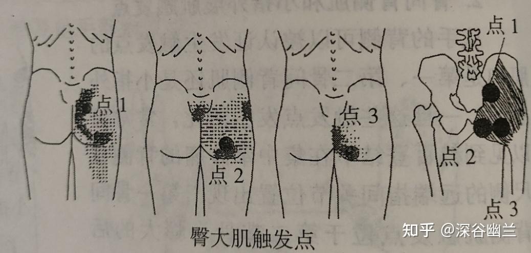 臀部肌肉注射的危险区图片