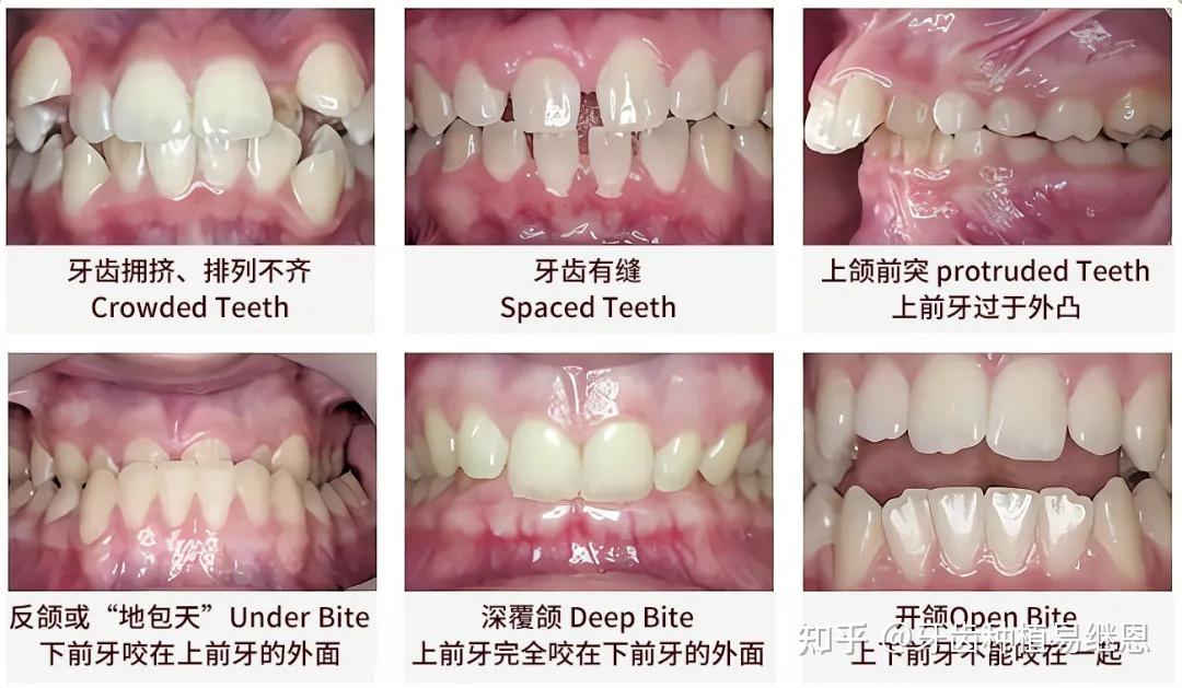 各种畸形牙的分类图片图片