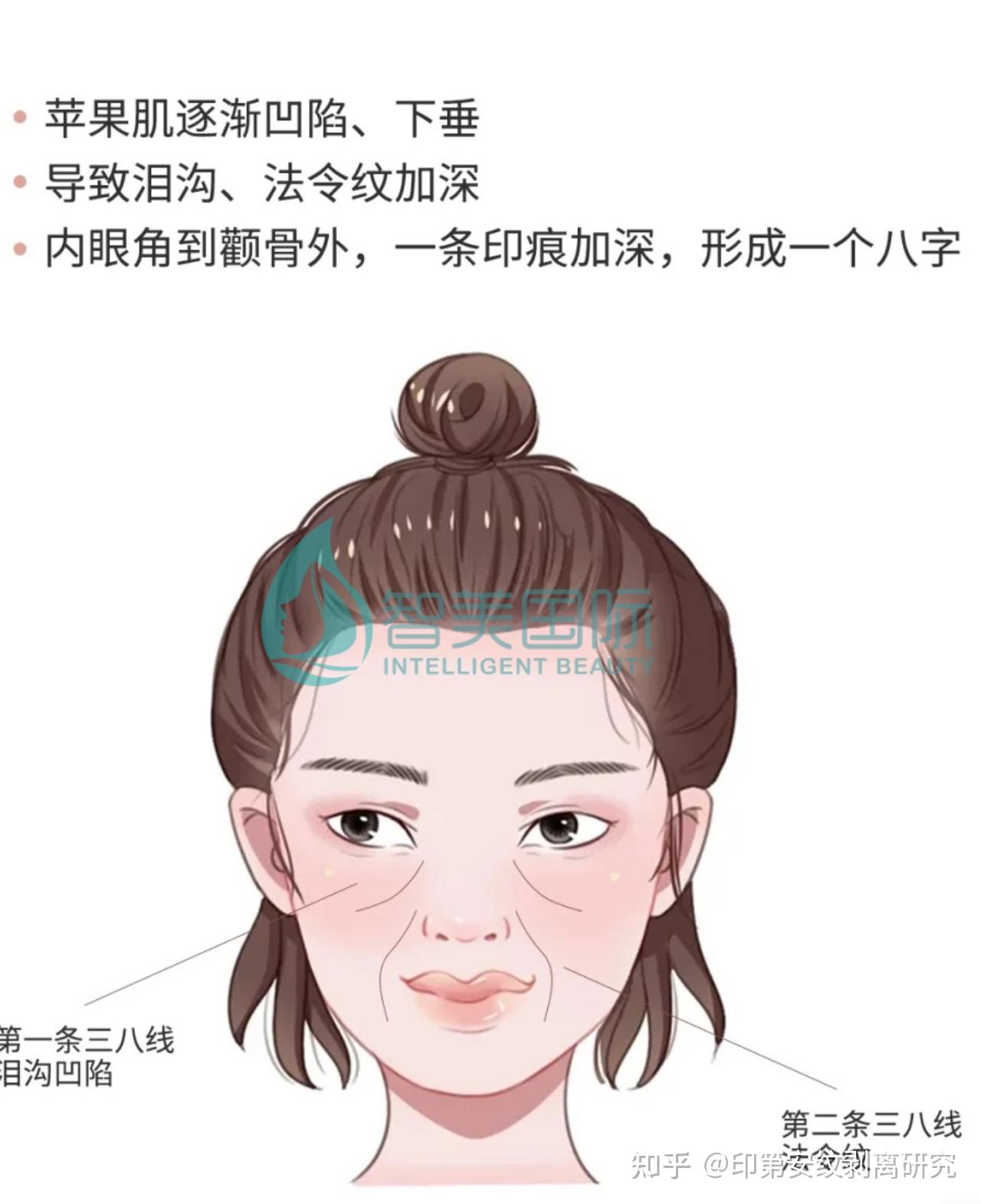 【面部轮廓整形诊疗指南 07】 北京&成都八大处颧骨内推 下颌角手术 颏部手术后肿胀期及头套佩戴 - 知乎