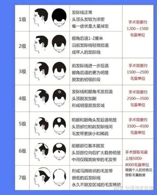 在网上找了一张图,这张图将人们的头发状况分为七级,不同级别的脱发
