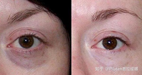 2分钟去黑眼圈 眼袋 推荐四件去黑眼圈产品 知乎