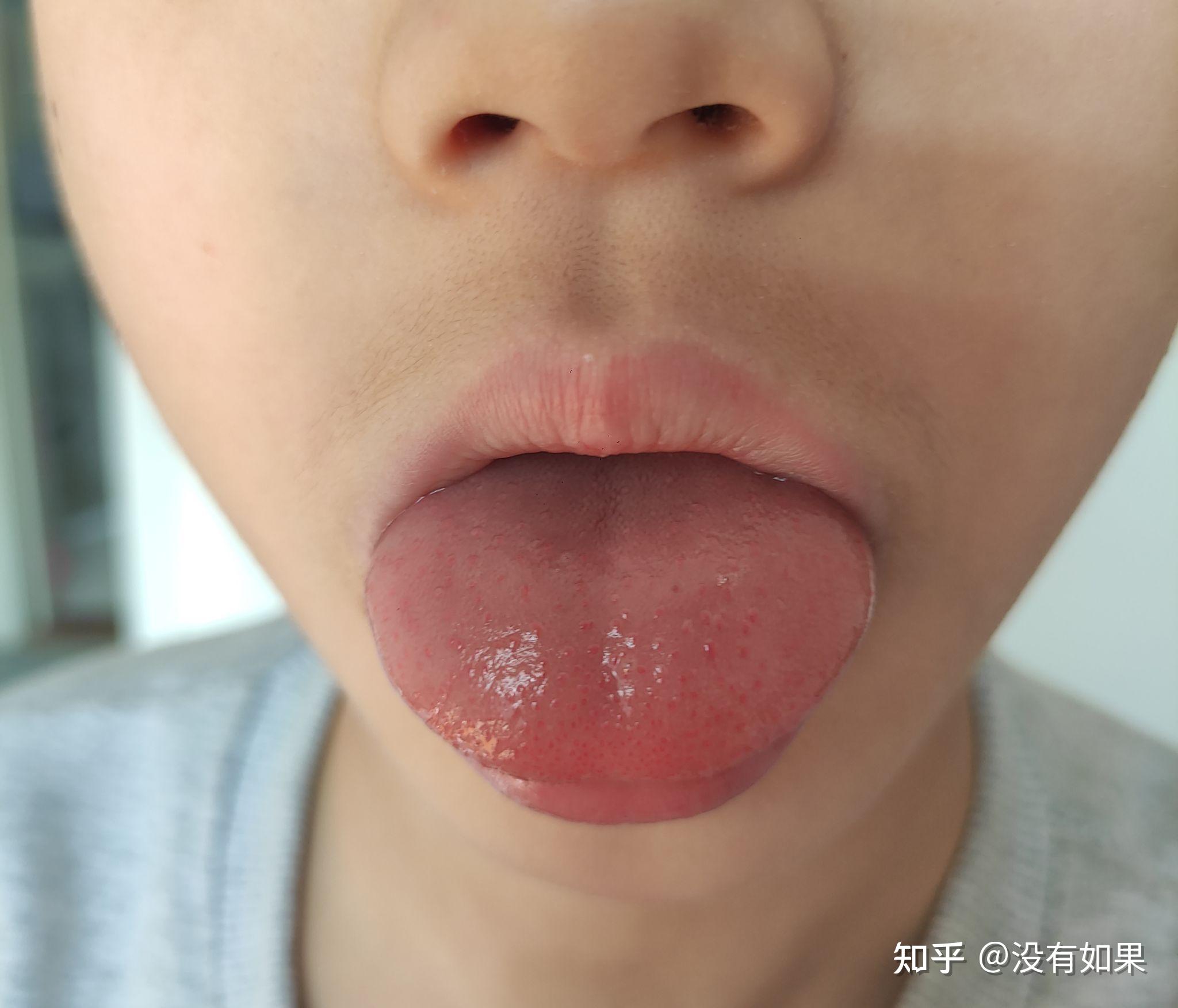 宝宝草莓舌头图片图片