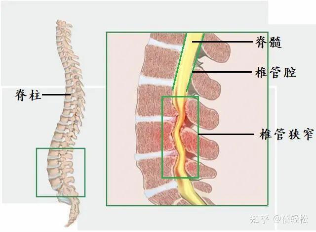 從上圖可以看出,人體脊柱中間容納脊髓的管腔是椎管,椎管的大小寬度