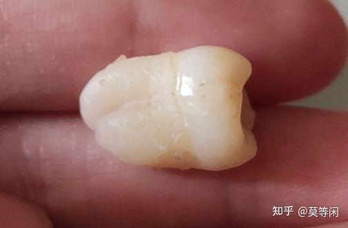 拔右上智齿的感觉和过程