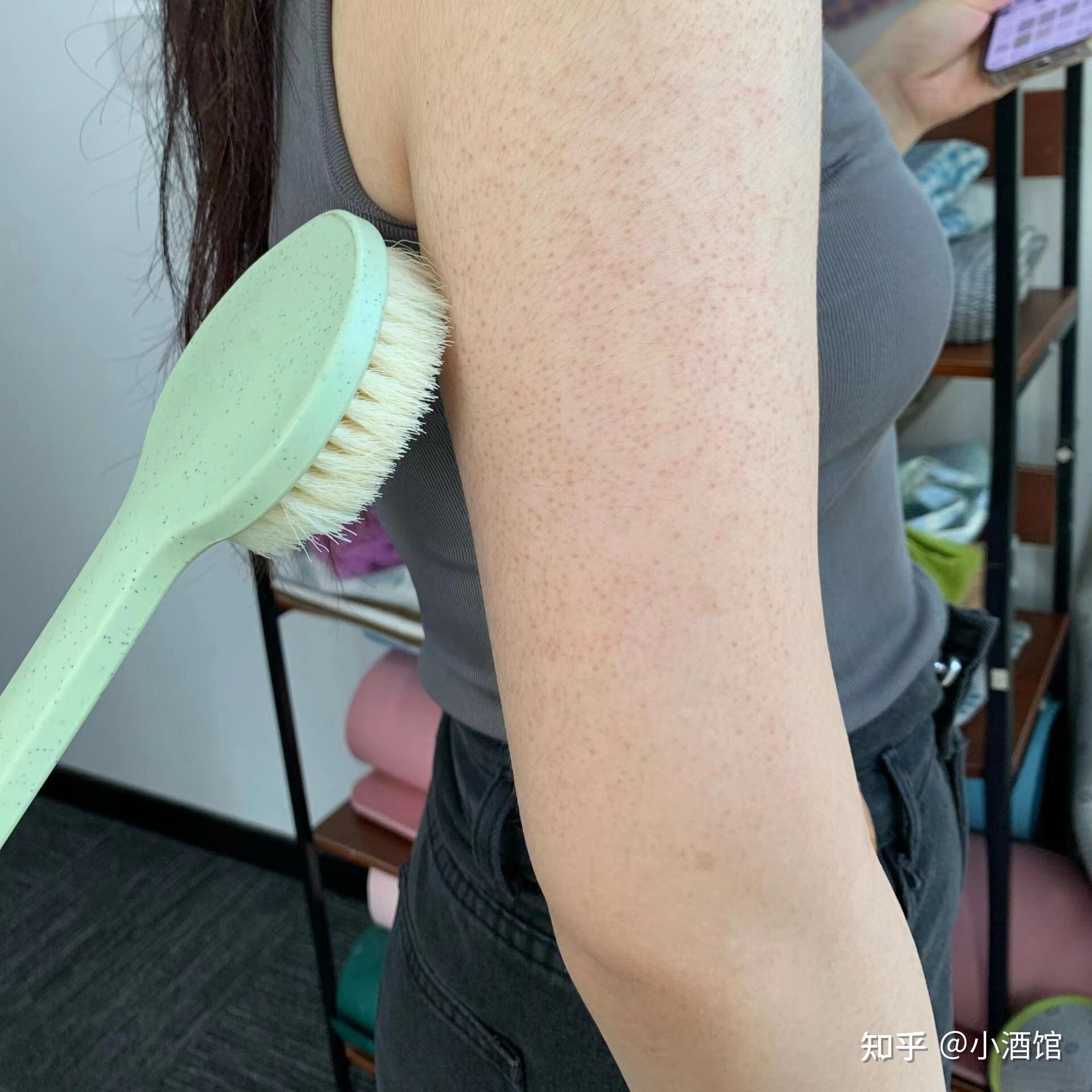 身上的鸡皮肤图片 v2-ca2225c3534f4f6cd9310e08b184d420_r.jpg