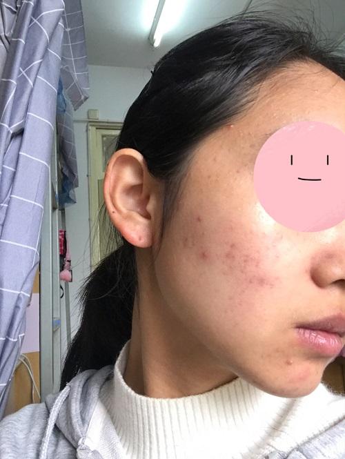 我脸上的红色痘印七八个月了一直不下去我该怎么办