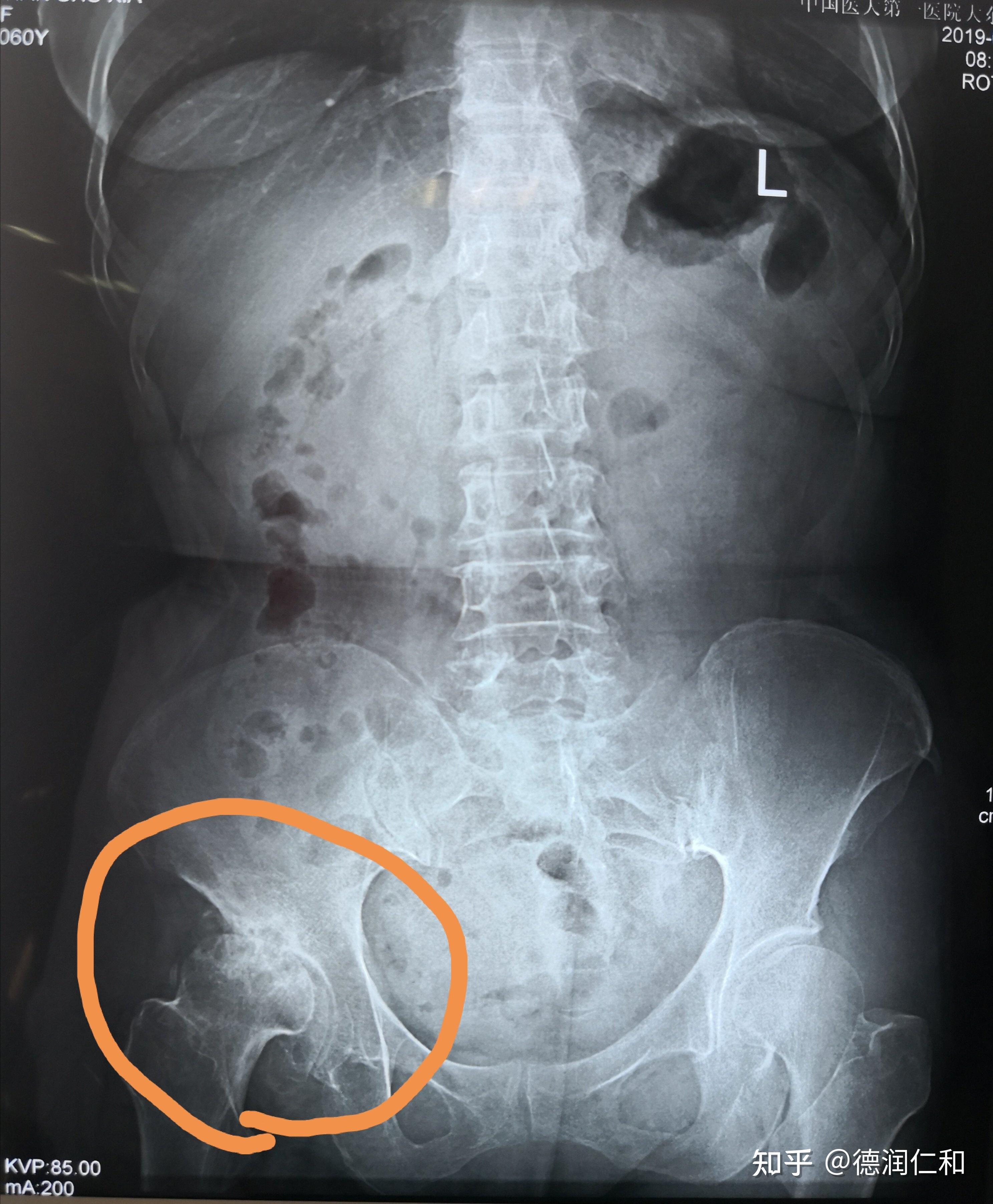 股骨头坏死有那些表现?