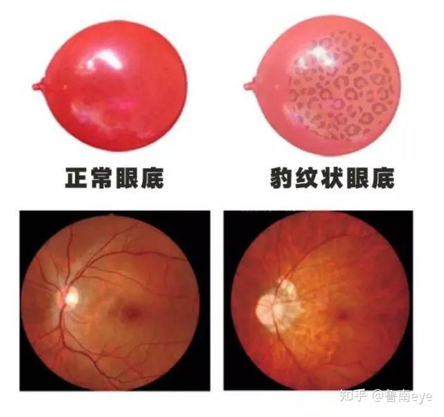 变薄,首先表现为视网膜色素上皮进行性变薄,视网膜血管离开视盘后即变