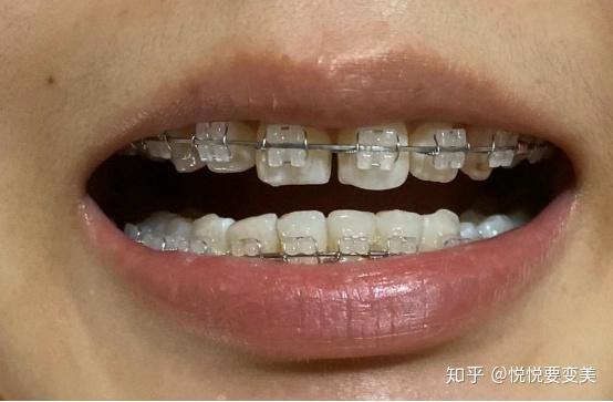 我为什么要选择陶瓷半隐形牙套?