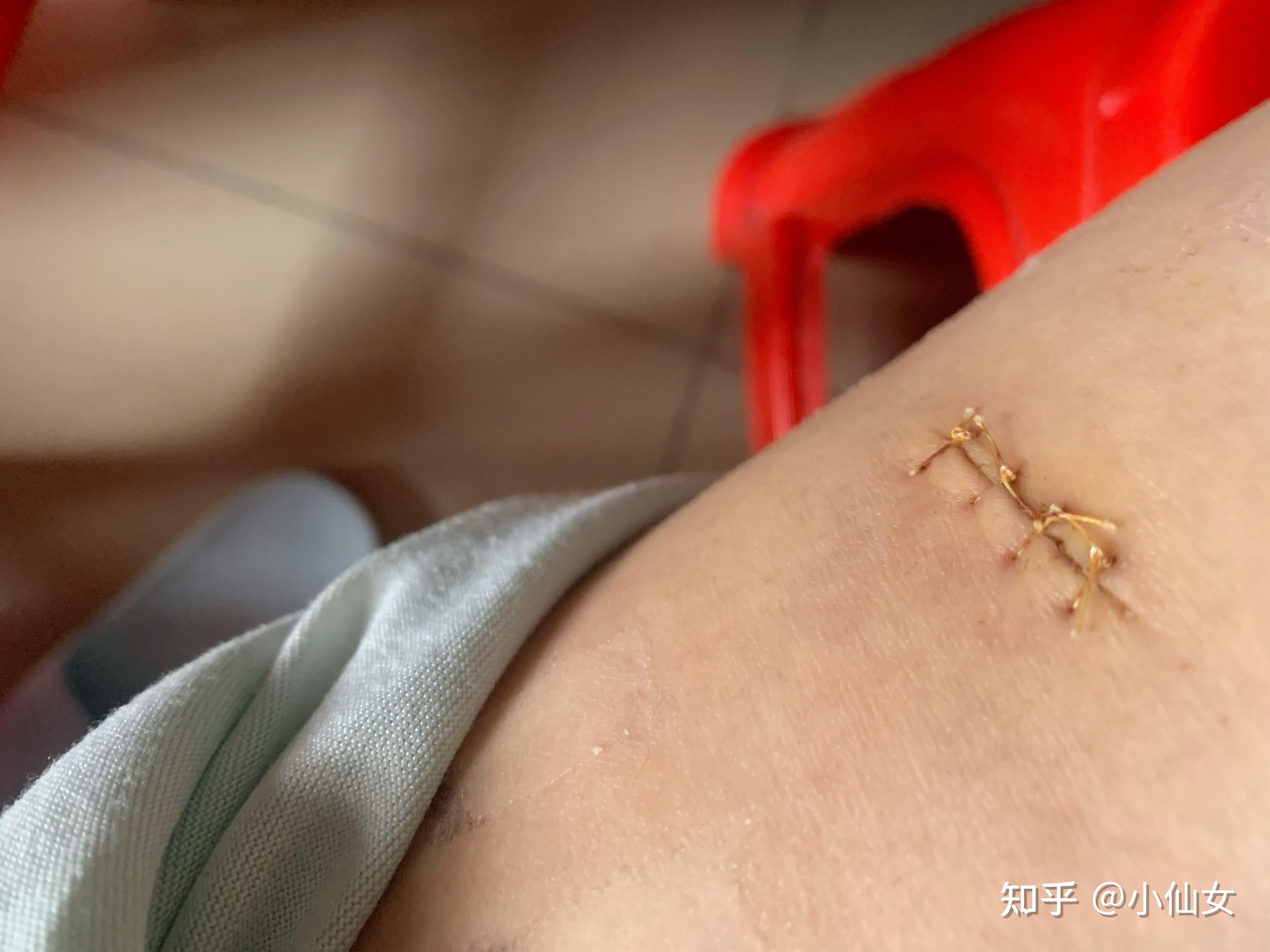 脂肪瘤手术分享