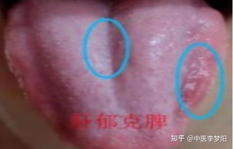 4种常见的脾虚舌象,脾气虚、脾阳虚、脾阴虚,看看你是哪一种! - 知乎