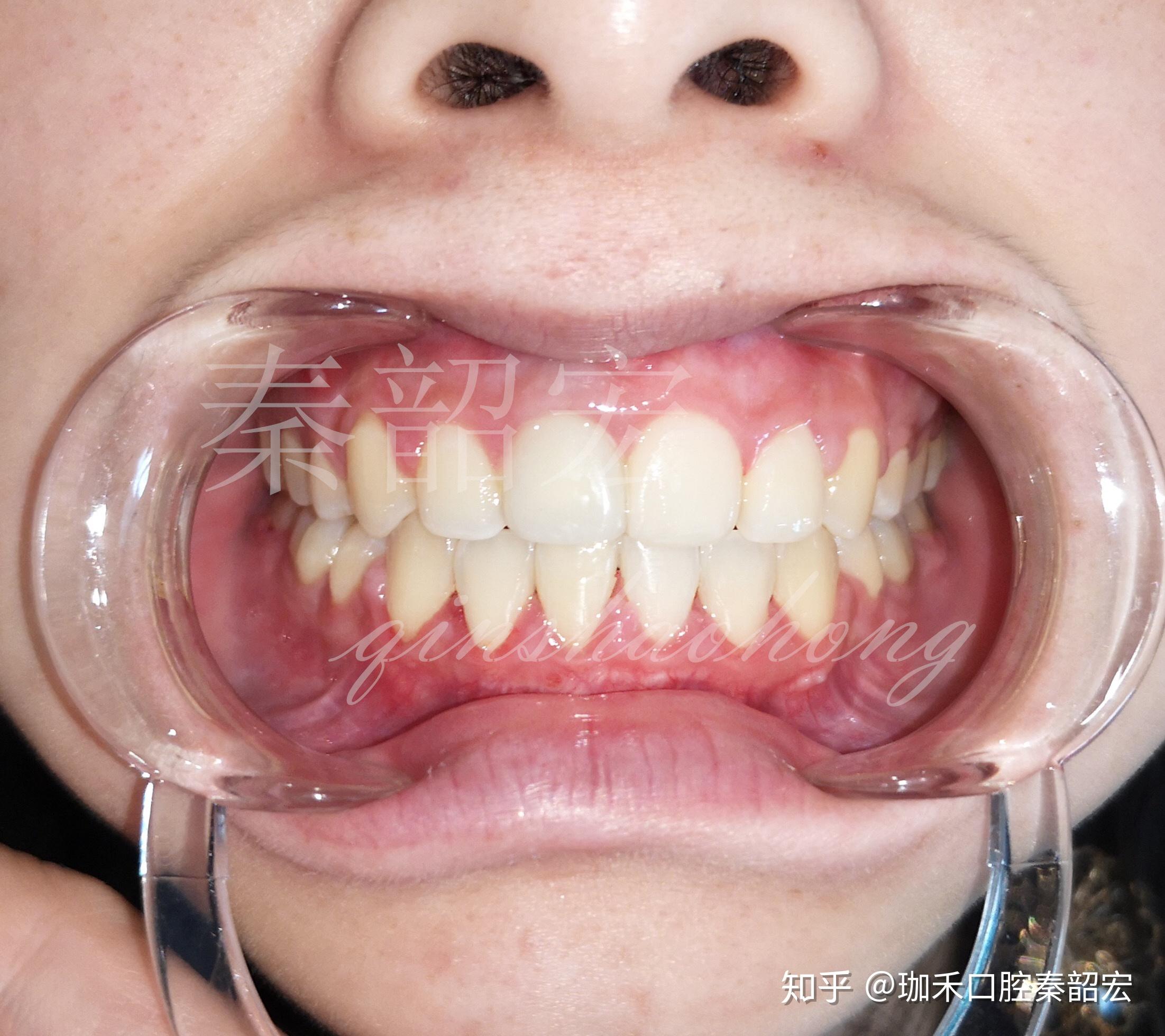 上下牙龈正常是什么样的图片?用一张标准的咬合图告诉你-欣美整形网