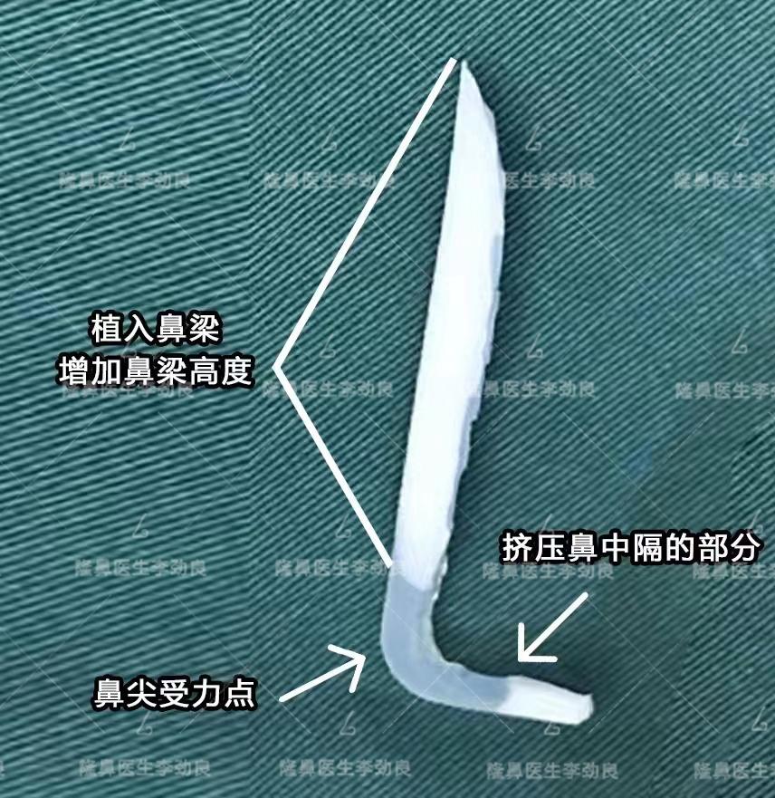 l型假体隆鼻真的很可怕吗