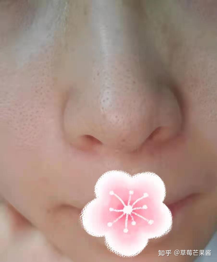 有哪些可以改善鼻翼两侧毛孔粗大和黑头现象的方法