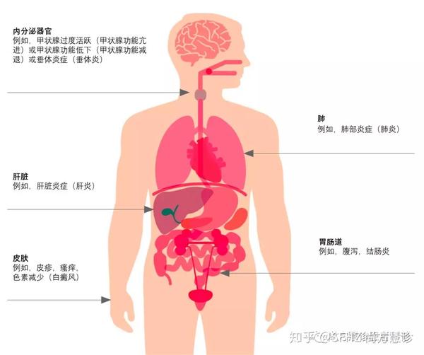 图示:检查点抑制剂治疗的副作用最常影响皮肤,结肠,内分泌器官(如垂体