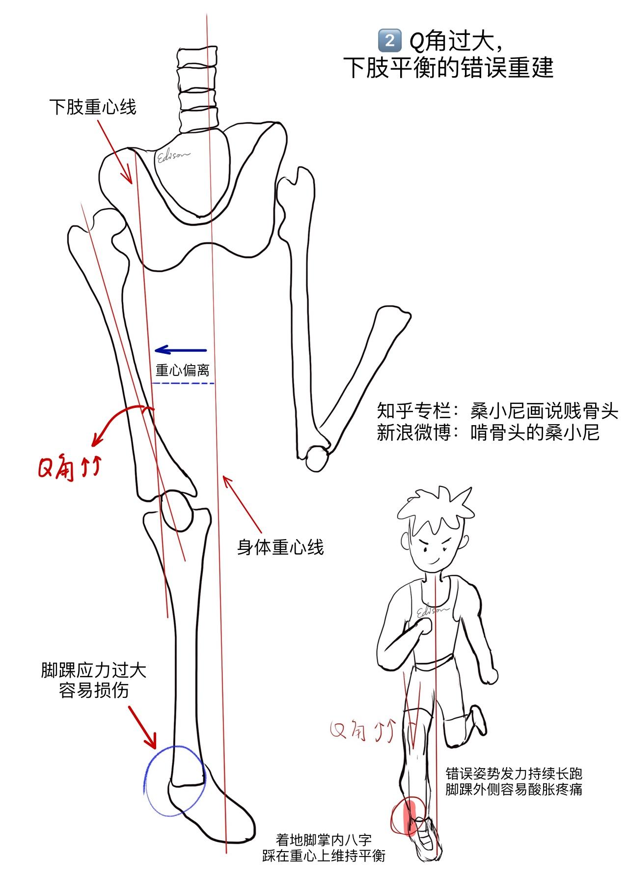 【腿型自测】各种腿型(x型 o型xo型)的自测方法 - 知乎