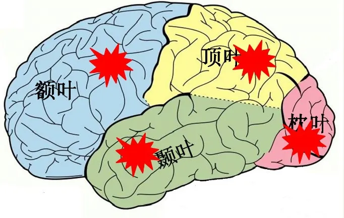 颞叶、枕叶、顶叶、额叶癫痫发病有何区别? - 知乎