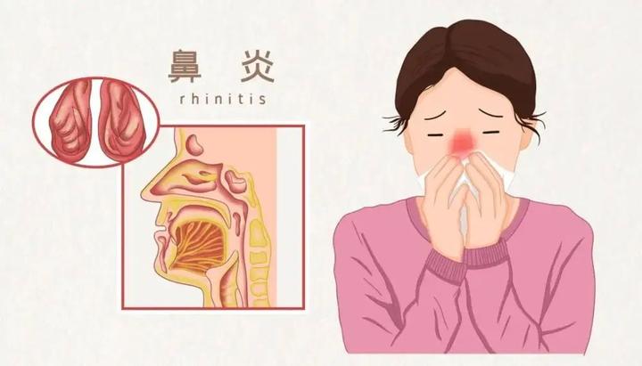 擤鼻涕竟会造成中耳炎、结膜炎?? - 知乎