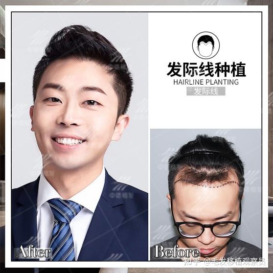 植发对颜值的改变有多大看看中德植发的他吧