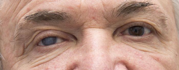 眼科知识:白内障的症状及自查表