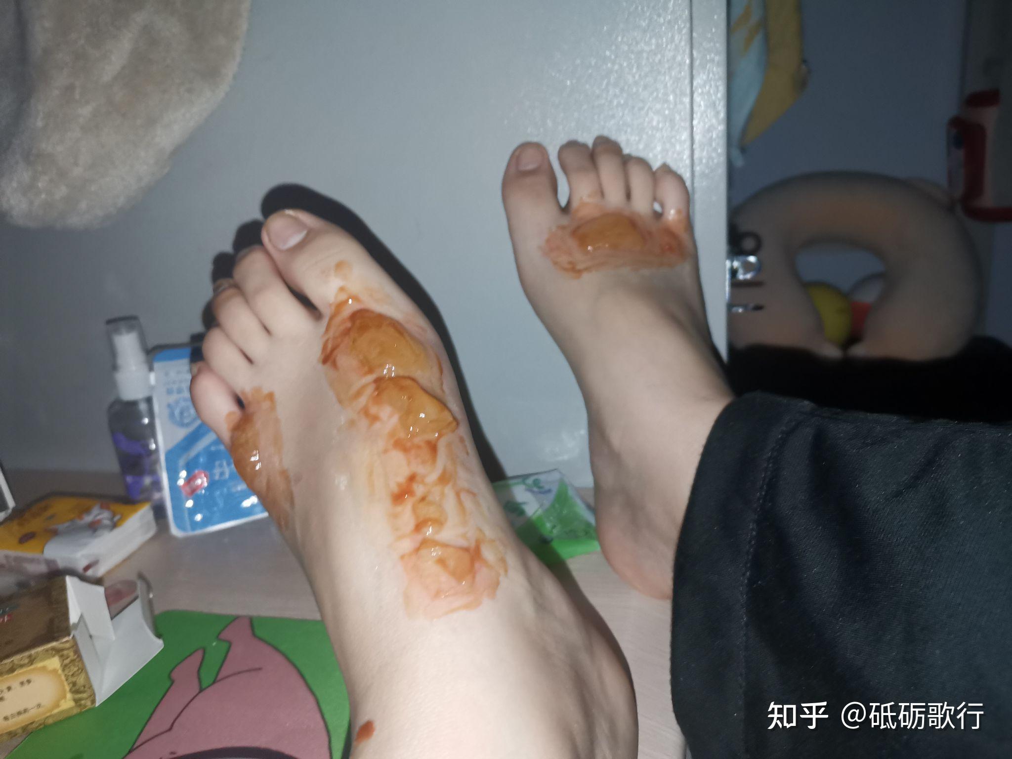 开水烫伤的恢复期记录