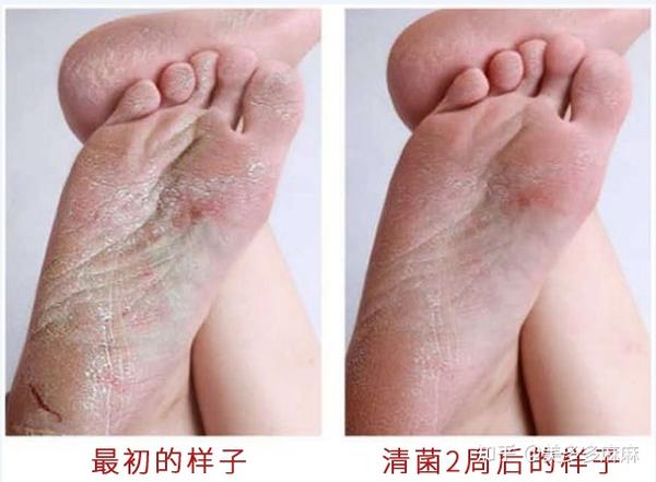 去除脚气的正确姿势