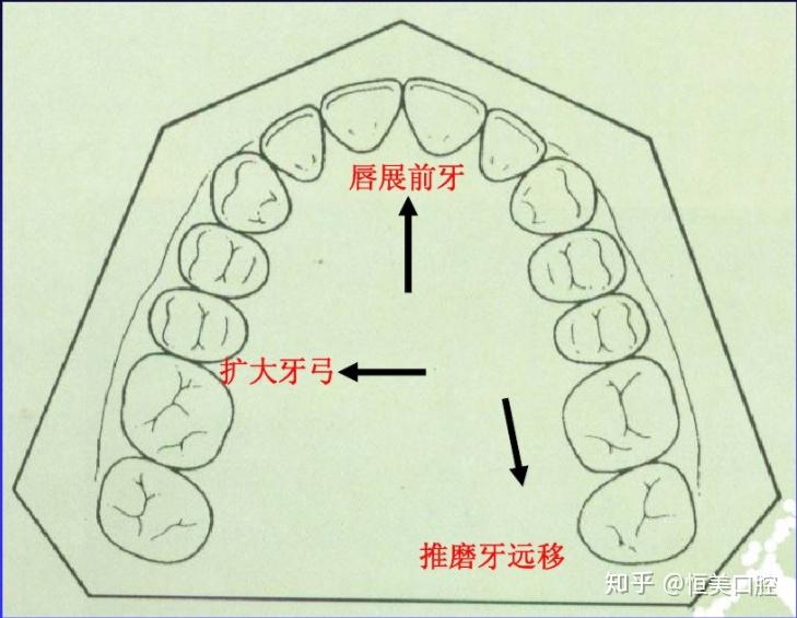今天就给大家分享一个不拔牙矫正的方法『推磨牙向后』.
