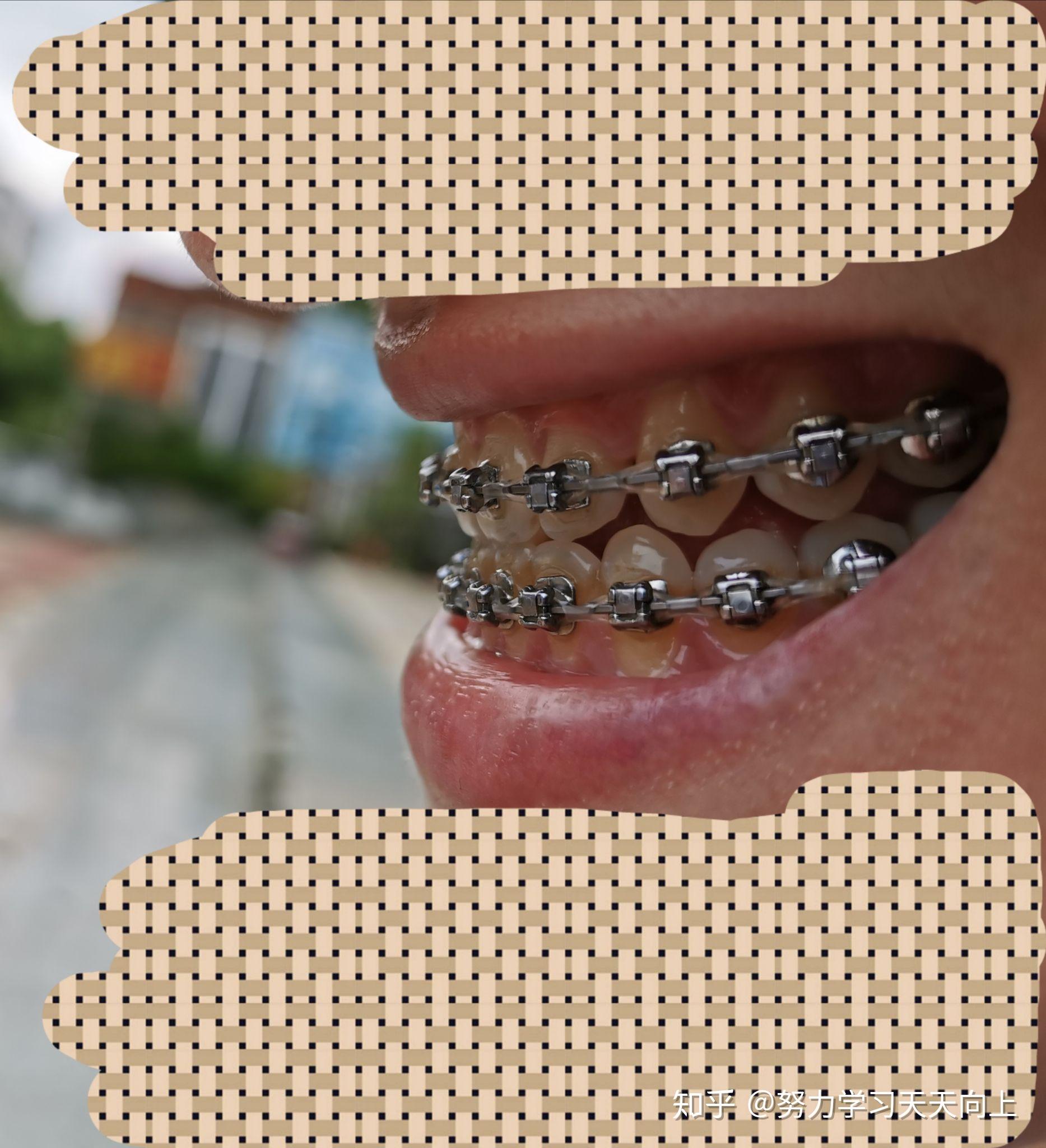 大龄牙套老阿姨的地包天正畸日记