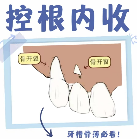 正畸时为何要进行控根移动? - 知乎