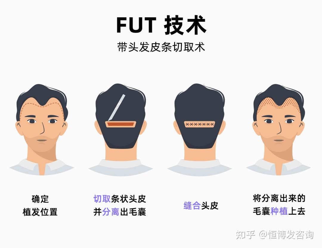 植发手术,主要分两种:fue(毛囊单位提取技术)和 fut(带头发皮条切取术