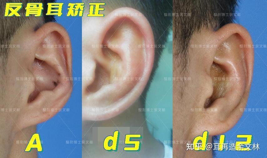 【案例分析】这个反骨耳患者耳骨外翻严重,他觉得不好看做手术修复了