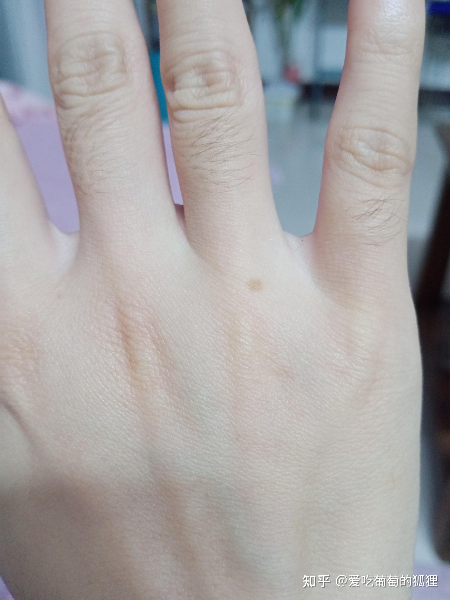 痣长在右手背有什么含义?