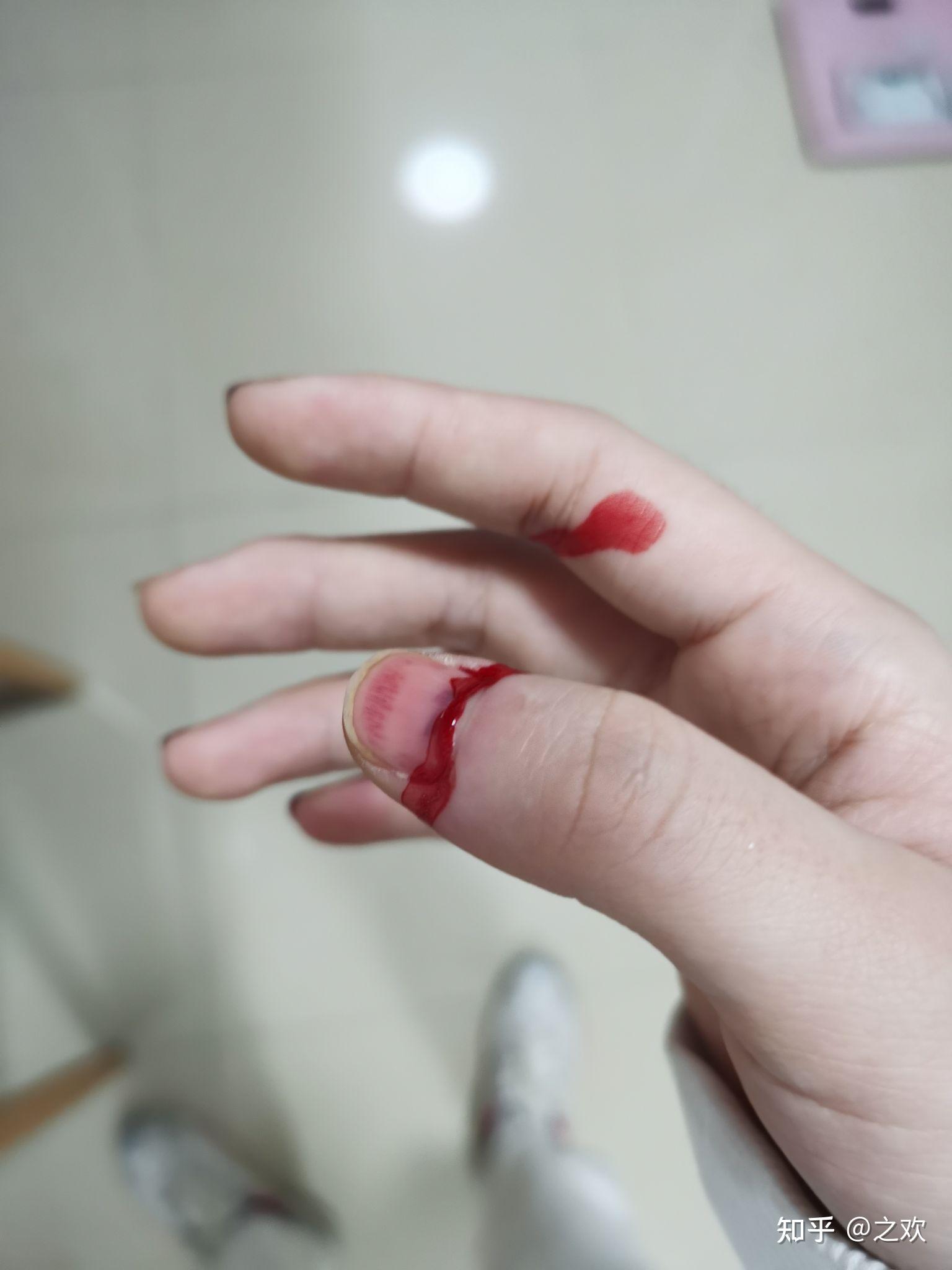 手指被门夹肿还夹出淤血是什么感受? - 知乎