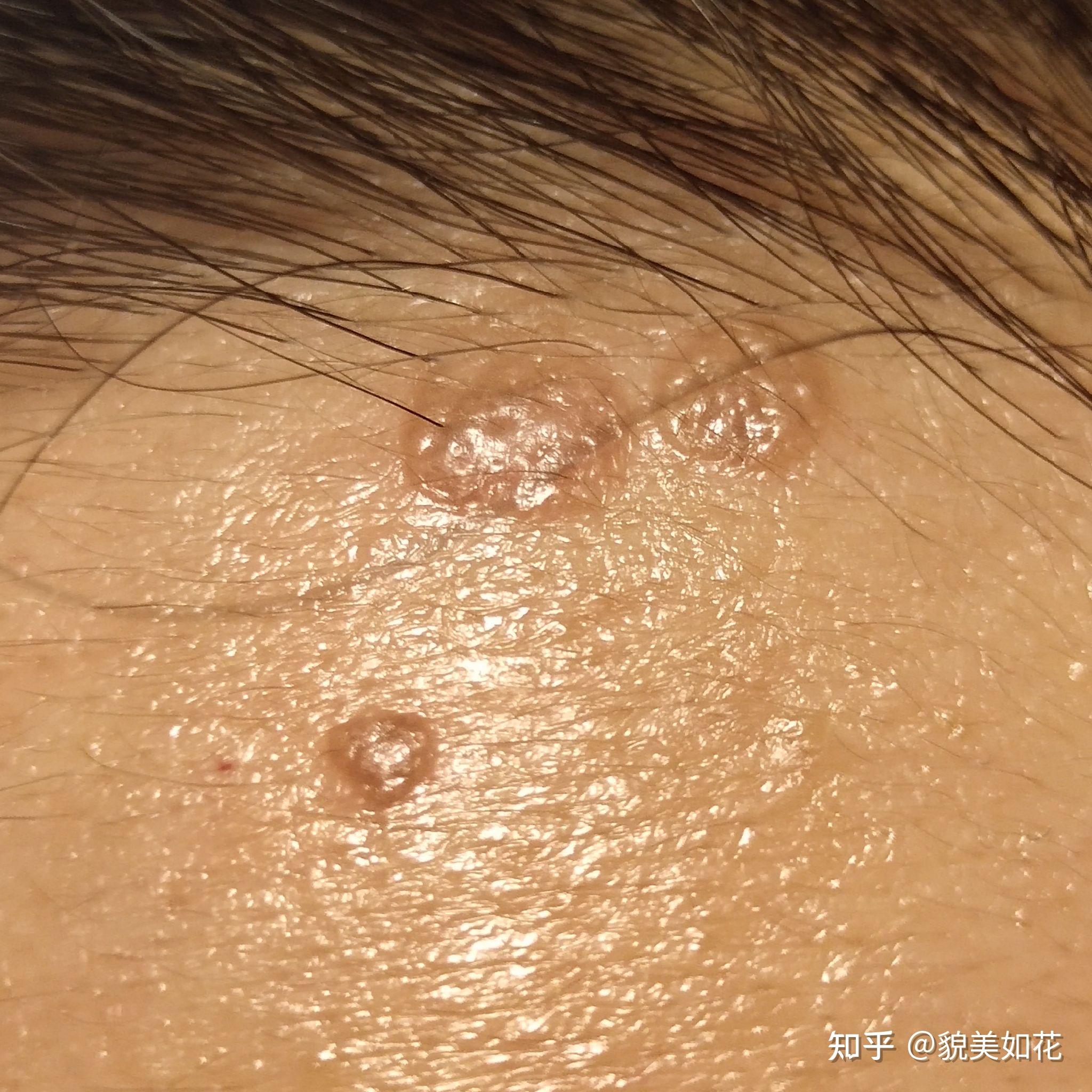 冷冻扁平疣恢复记录 - 知乎