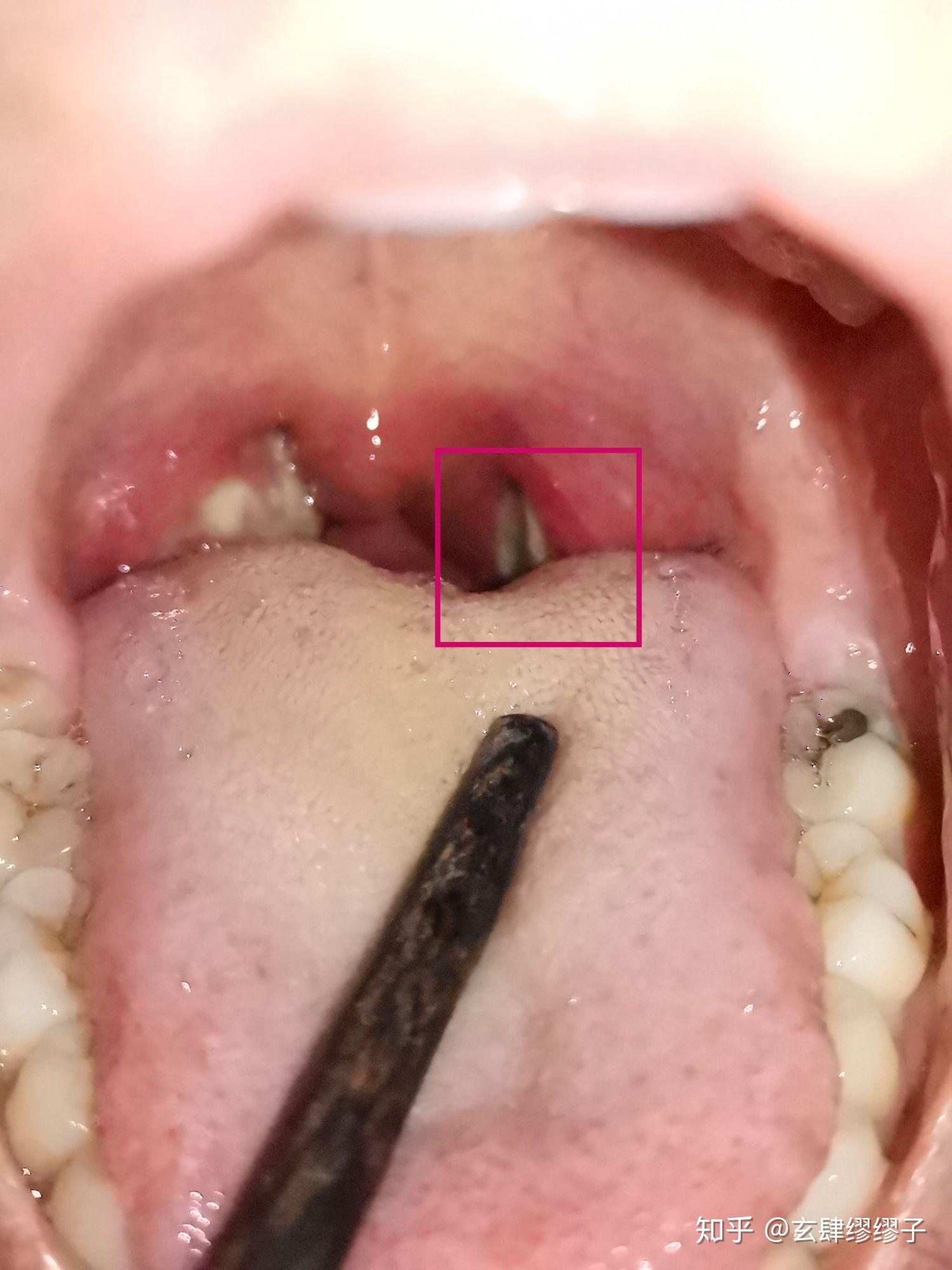 急性化脓性扁桃体炎的疼痛级别