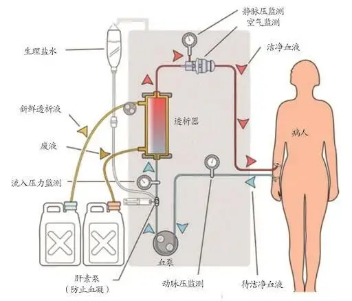 而慢性腎衰竭的患者腎功能損害,就無法過濾體內毒素甚至無法排尿.