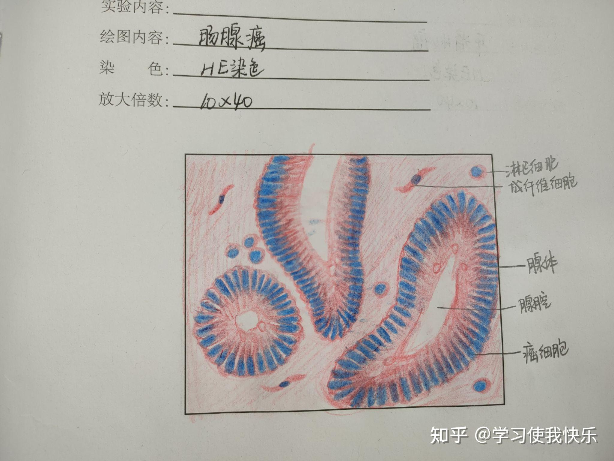 直肠腺癌手绘图片图片