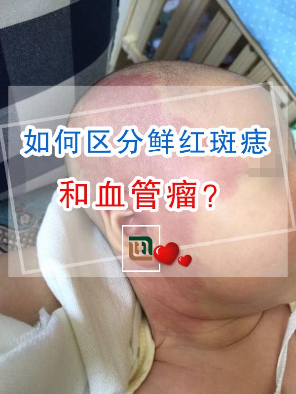 如何区分鲜红斑痣和血管瘤