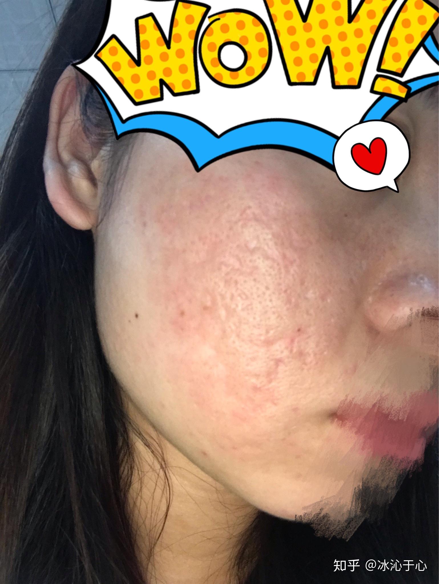 第二次做二氧化碳点阵激光修复痘坑 - 知乎