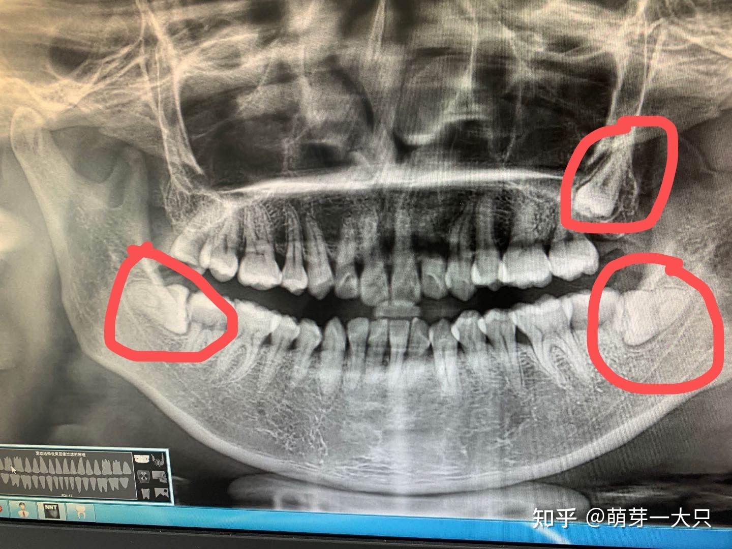 拔牙牙洞恢复过程图解分析（失去牙齿后，伤口要愈合多久？） | 说明书网