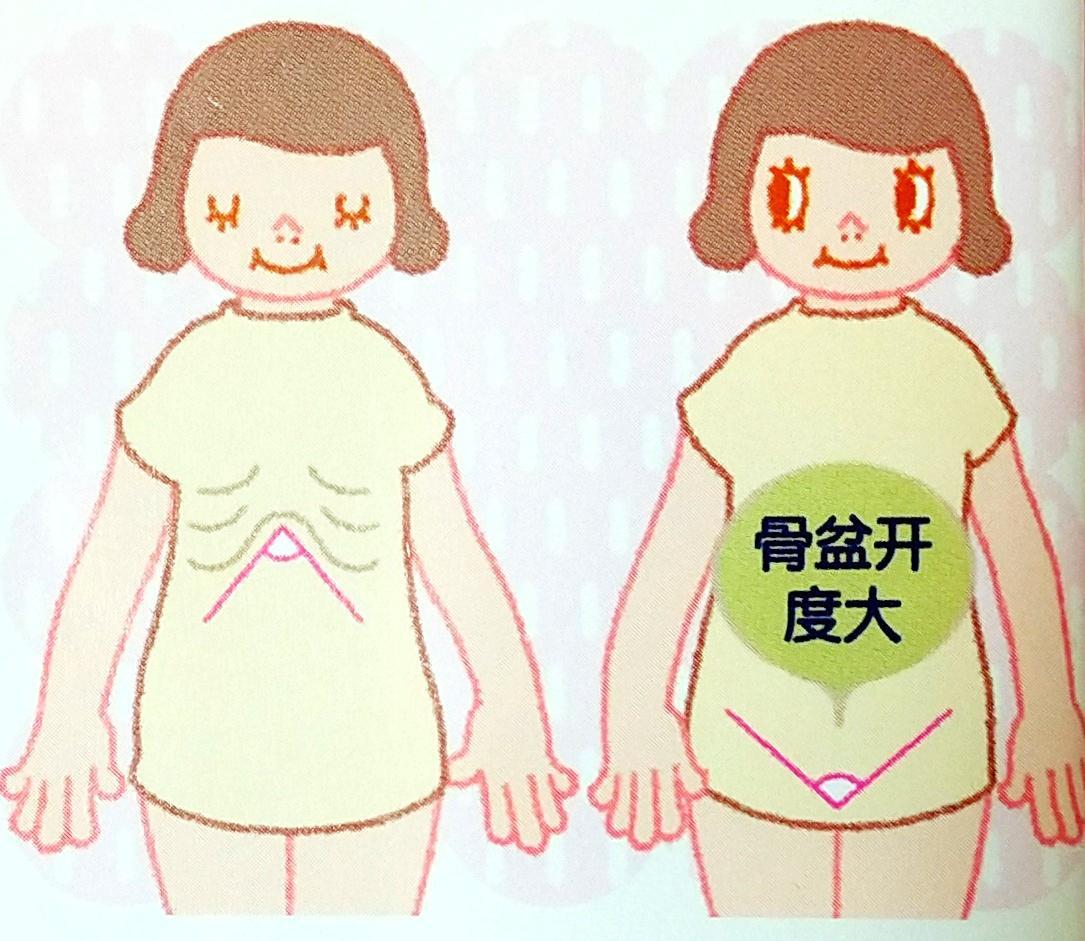 骨盆扩张过大检查你的骨盆是否需要闭合